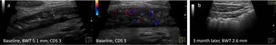 Monitoring of patients with active inflammatory bowel disease